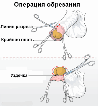 Схема операции обрезания