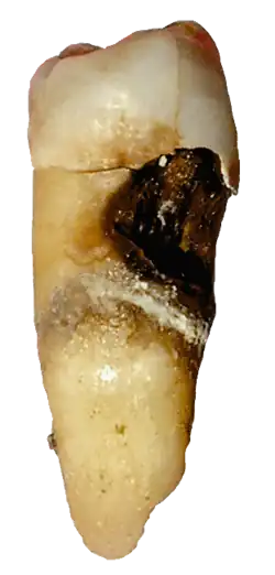 Расширенный кариес на премоляре