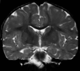 Вид фронтального среза головного мозга при метахроматической лейкодистрофии (МРТ).